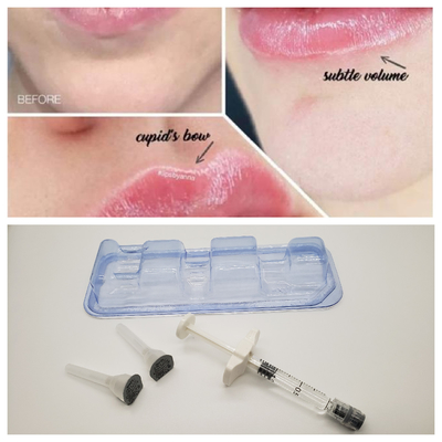 1 ml Juvederm Medical Sodium Hyaluronate Gel Hidaluronik Asit Gel Injeksiyon Burnun Köprüsü için