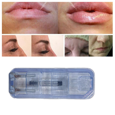 Çapraz Bağlı Hyaluronik Asit Dudak Yüzü 2ml Dermal Dolgu