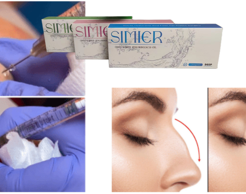 Gülüş çizgilerini doldurmak için şeffaf 10ml Sodyum Hyaluronate Gel Enjeksiyon Tedavisi