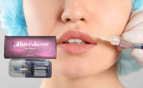 2 * 1 ml Juvederm Ultra 3 Dudak Dolguları Hyaluronik Asit Gel Dolguları