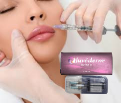 2 X 1 ml Juvederm Ultra 4 Enjekte edilebilir Dermal Filler Dudak Filler Enjeksiyonları