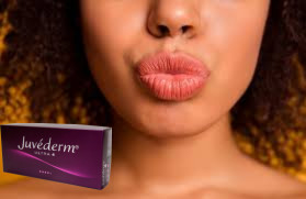 Juvederm Ultra 3 Ultra 4 Dudak Büyütme için Hiyaluronik Asit Dolgu