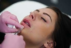 Hyaluronik Asit Enjekte edilebilir Dermal Filler Juvederm Ultra 3 1mlx2